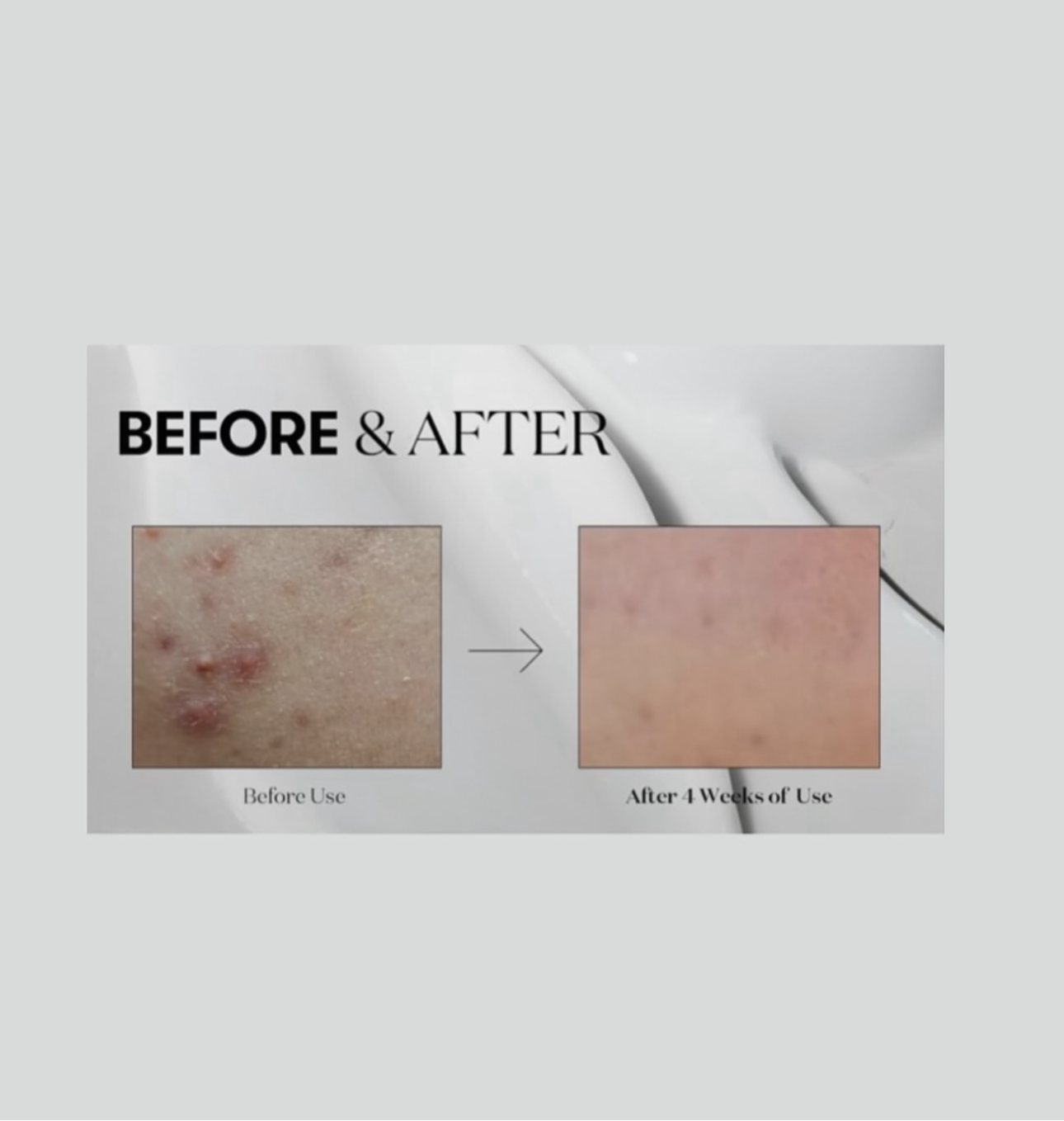 VT Reddle Shot - Microneedling at Home